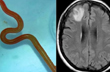 In world’s first, live parasitic worm found in Australian woman’s brain